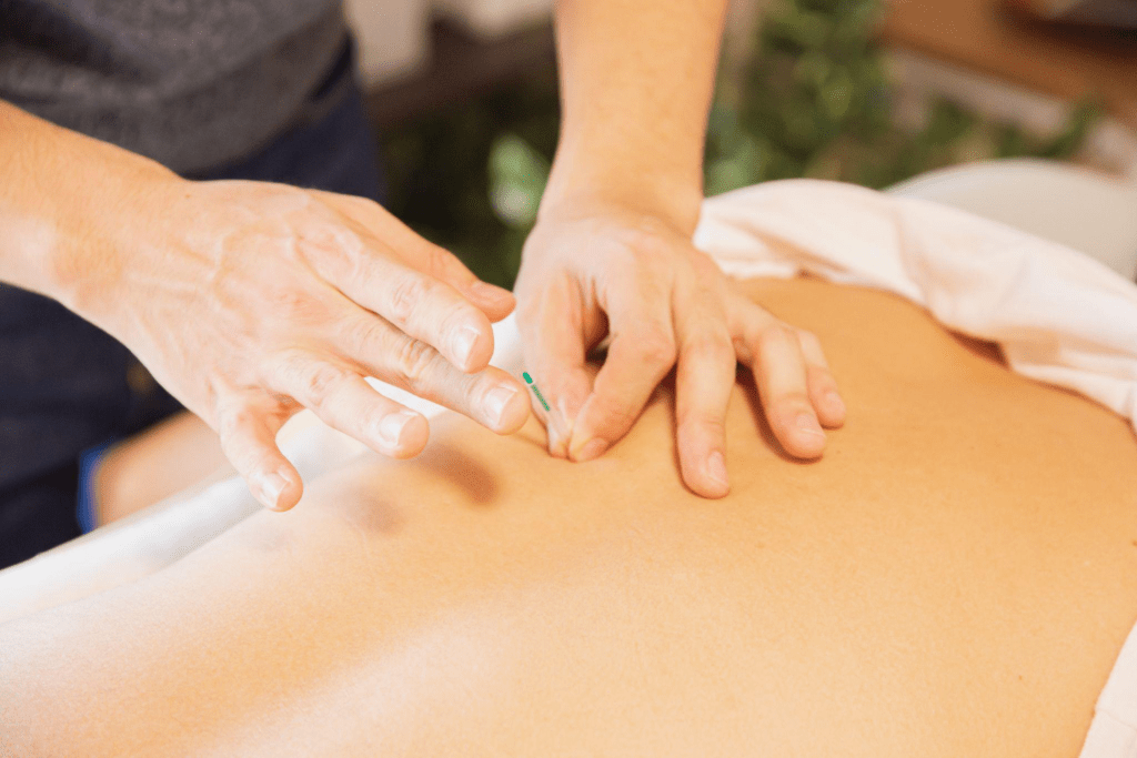 Therapist treating patient with needles